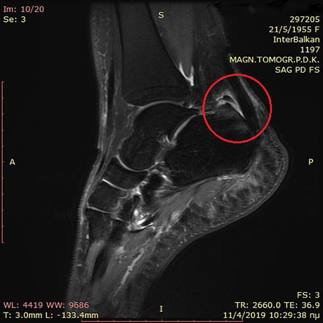 HAGLUND DEFORMITY - RETROCALCANEAL BURSITIS | Γεώργιος Δ. Γκουδέλης
